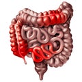 Crohn Disease Medical Illness
